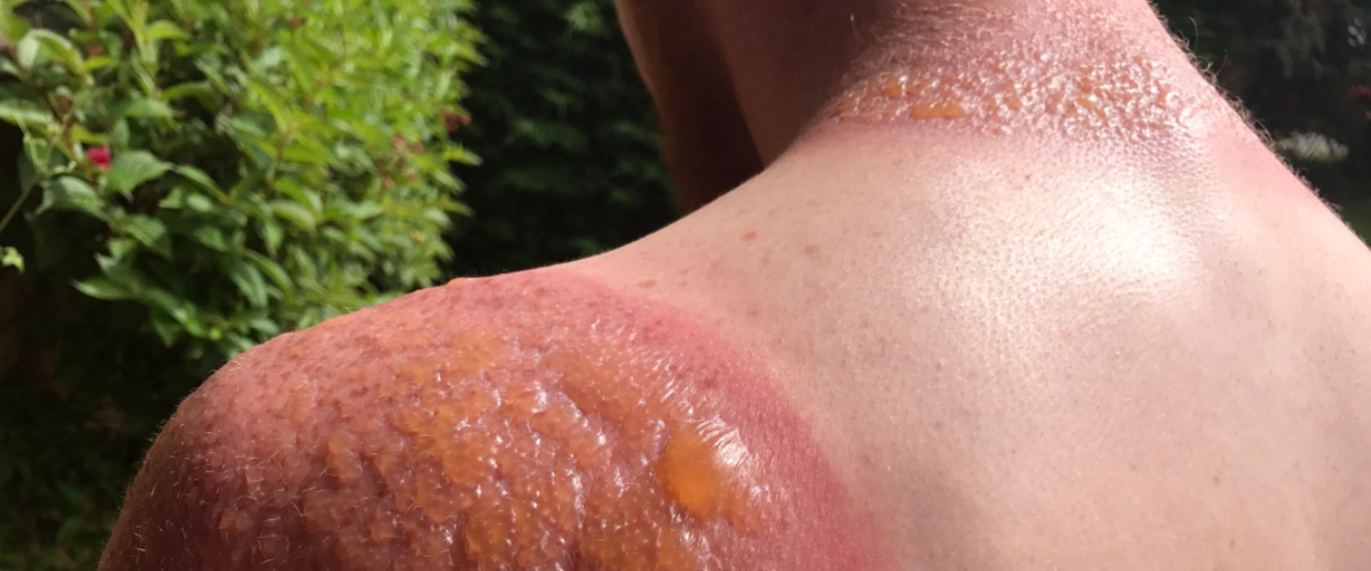 The Science Behind Healing Second-Degree Sunburns