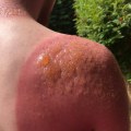 When to Seek Medical Help for Second-Degree Sunburns: A Medical Professional's Perspective