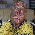 The Resilience of the Human Body: A Case Study of Surviving 6th Degree Burns