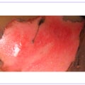 Understanding the Different Types of Burns