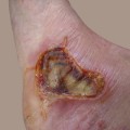 The Truth About 6th Degree Burns: Understanding the Severity and Debunking Myths