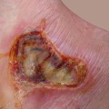 Expert Tips for Identifying 2nd and 3rd Degree Burns: A Comprehensive Guide