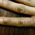 The Importance of Understanding the Different Degrees of Burns