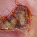 Expert Insights: Understanding the Different Degrees of Burns